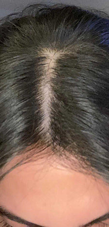 Customer before using HAIRtamin MOM - scalp baldness