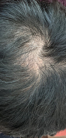 Customer before using HAIRtamin - scalp baldness