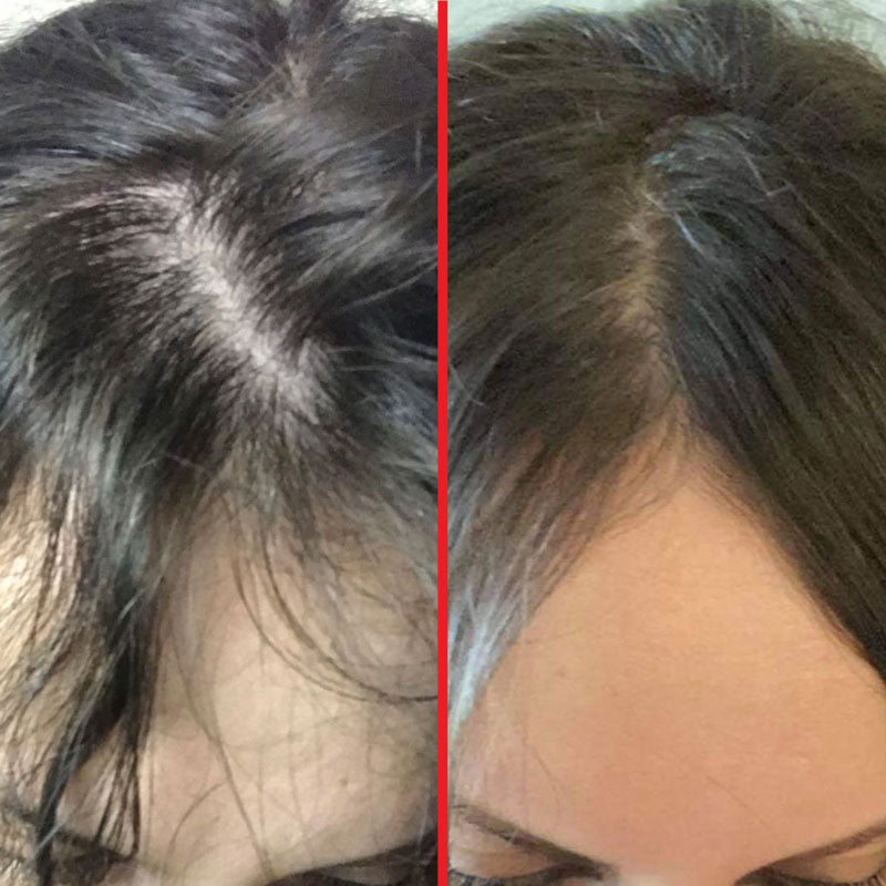 Hair Regrowth Supplement for Alopecia - Thicker Stronger Hair and Follicle  Regeneration - Vegan Capsules