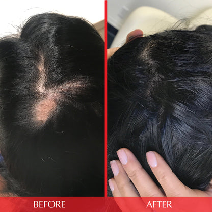 before and after photo of bald spot